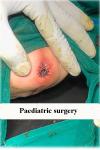 paediatric-surgery